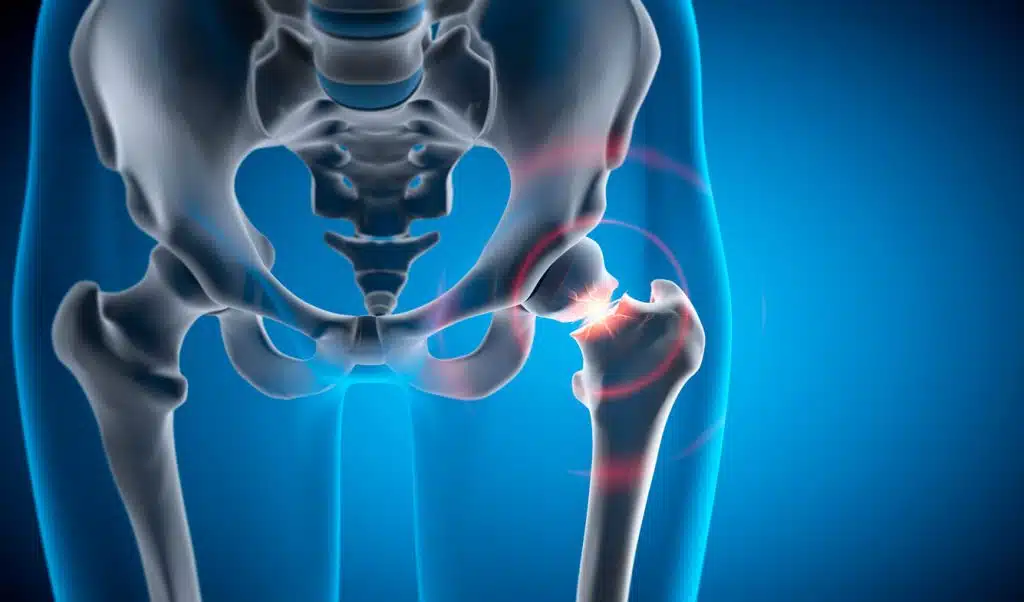 3D illustration of a hip joint with a painful fracture that requires the attention of a hip replacement surgeon.