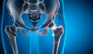 3D illustration of a hip joint with a painful fracture that requires the attention of a hip replacement surgeon.