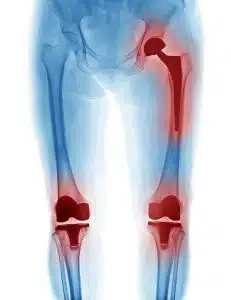 X Ray image of hip replacement and knee replacement