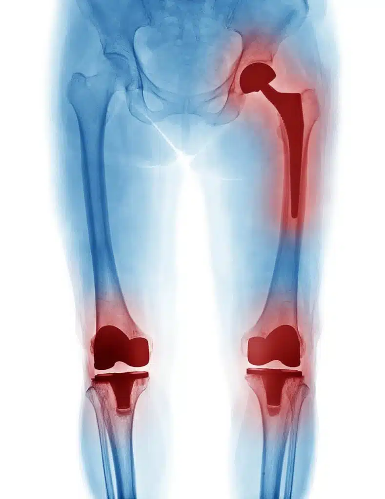 X Ray image of hip replacement and knee replacement